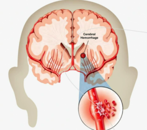 دانلود پاورپوینت سکته مغزی – علائم، اقدامات تشخیصی و درمان آن | 16 صفحه